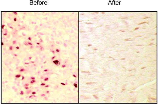 Figure 1. Absence of NPC tumor cells in nasopharynx after treatment. Biopsies taken before (left) and after (right, representative of 7 biopsies) the administration of EBV-specific CTLs as adjuvant treatment in a patient with refractory NPC (P894) were analyzed for the presence of EBV-positive tumor cells by in situ hybridization for EBER using a digoxigenin/alkaline phosphatase-labeled probe (Sigma-Genosys, The Woodlands, Texas). Stained slides were examined with a Zeiss Microscope (Axioscope, Carl Zeiss, Thornwood, NY) at 200 × magnification using a Pan NeoFluar lens (20 ×/0.50). Images were captured using a Spot Insight camera and software (3.4 P.C.) (Diagnostic Instruments, Sterling, MI).