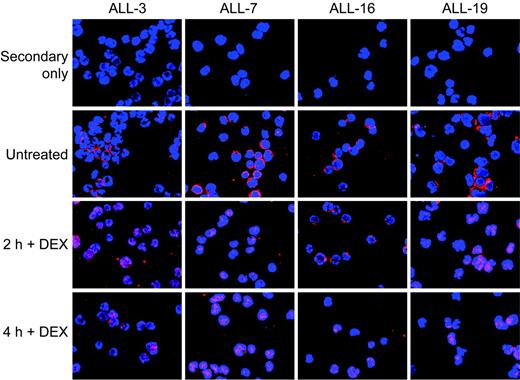 Figure 3. Immunofluorescence detection of nuclear translocation of the GR in xenografts ALL-3, ALL-7, ALL-16, and ALL-19. Xenograft cells were retrieved from cryostorage and exposed to dexamethasone (1 μM) for up to 4 hours prior to cytocentrifugation onto microscope slides and staining with GR antibody. GR was detected using Cy3-labeled secondary antibody (red), and slides were counterstained with DAPI to indicate nuclei (blue). Images were captured using a fluorescent microscope equipped with a cooled CCD camera, under a 63 × oil-immersion objective. Fields shown are representative of at least 5 imaged fields.