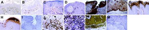 Figure 7. Expression of CXCL12 in HPV lesions from patient with and without WHIM. CXCL12 immunostaining of control skin samples: healthy skin (A), seborrheic keratosis (B), inflammatory skin (C), and epidermoid carcinoma (D). CXCL12 expression in WHIM wart epidermis (E), WHIM dysplastic condyloma epidermis (F), non-WHIM wart (G), non-WHIM condyloma (H). WHIM wart epidermis (same specimen as in panel E) immunostained with IgG2a isotype-matched control antibody (Ab) (I). CXCL12 expression in non-WHIM (J) and WHIM (K) dermal mononuclear infiltrates. Cells with fibroblast (arrows) or dendritic cell morphology (arrowheads) are shown (J-K). CXCR4 immunostaining of WHIM wart dermis and epidermis (L). The same specimen was similarly processed with IgG1 isotype-matched control Ab (M). Original magnification, × 400 (A-C,G,H), × 200 (D-F,I), × 600 (J-K), × 100 (L-M).