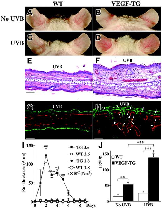 Figure 2. VEGF promotes acute photodamage and UVB-induced skin angiogenesis. Macroscopic appearance of ears in sham-irradiated wild-type (A) and VEGF-overexpressing (B) mice is shown as control. No major changes were seen in the ear skin of wild-type mice (C) 48 hours after UVB irradiation with 3.6 × 10-2 J/cm2, whereas VEGF transgenic mice developed marked erythema (D). Histologic analysis revealed that the ear skin of wild-type mice was normal, with (top) or without (bottom) UVB irradiation (E; hematoxylin-eosin stain). In contrast, the ear skin of VEGF-overexpressing mice showed epidermal hyperplasia, dermal edema, inflammatory cell infiltration, and vessel dilation after UVB irradiation (top) compared with the nonirradiated skin (bottom) (F). Double immunofluorescence staining revealed dilated CD31+ vessels (red) that contained proliferating endothelial cells (Ki-67 stain; yellow; arrowheads) in the skin of VEGF-overexpressing mice and in proliferating epidermal keratinocytes, labeled with Ki-67 (green; arrows; H). No such changes were seen in the skin of wild-type littermates (G). Scale bars, 200 μm. A Plan Fluor 10 × objective with an aperture of 0.30 was used for panels E-H. (I) VEGF-overexpressing mice showed significant ear swelling 48 hours after irradiation with 3.6 × 10-2 J/cm2 UVB (▪) but not with 1.8 × 10-2 J/cm2 UVB (•). No ear swelling was observed in wild-type littermates irradiated with 1.8 × 10-2 J/cm2 (○) or 3.6 × 10-2 J/cm2 UVB (□). Ear thickness in VEGF transgenic mice returned to original levels 7 days after UVB irradiation (I). Ear swelling is expressed as the increase (Δ) over the original ear thickness in micrometers. (J) VEGF ELISA of skin lysates revealed enhanced VEGF protein levels in the ear skin of VEGF-overexpressing mice (▪) 48 hours after UVB irradiation compared with transgenic mice that did not undergo UVB irradiation or with wild-type mice (□). Data are expressed as mean ± SEM (n = 3 per condition and time point). ***P < .001; **P < .01.
