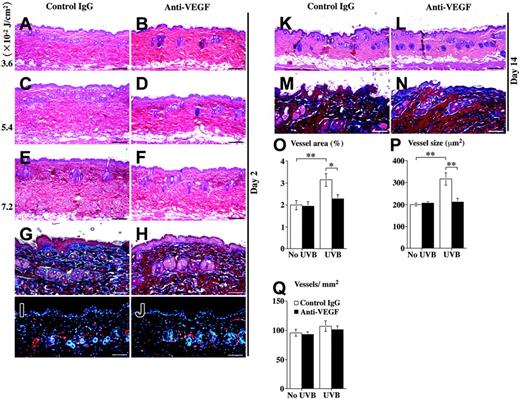 Figure 4. Systemic treatment of wild-type mice with a neutralizing anti-VEGF antibody results in reduced photosensitivity but does not inhibit tissue repair. The dorsal skin of IgG-treated wild-type control mice appeared healthy after a single irradiation with 3.6 × 10-2 J/cm2 (A), but edema was observed after exposure to 5.4 × 10-2 J/cm2 UVB (C). Systemic blockade of VEGF inhibited tissue swelling after a single UVB irradiation with 5.4 × 10-2 J/cm2 (D). After UVB exposure of 7.2 × 10-2 J/cm2, tissue edema and inflammatory cell infiltration were pronounced in control IgG (E) and anti–VEGF antibody-treated mice (F). Hematoxylin-eosin stain (A-F). Degradation of extracellular matrix was found in control IgG-treated mice after UVB exposure of 7.2 × 10-2 J/cm2 (G), but not in anti–VEGF antibody-treated mice (H). Trichrome stain (G-H). Immunofluorescence analysis with an antibody against CD31 revealed dilated vessels in the papillary dermis of control IgG-treated mice by 48 hours after UVB irradiation with 5.4 × 10-2 J/cm2 (I), but not in anti–VEGF antibody-treated mice (J). Nuclei are labeled blue (Hoechst stain). At 14 days after exposure to a UVB dose of 7.2 × 10-2 J/cm2, no signs of tissue edema or cutaneous damage (K-L, hematoxylin-eosin stains) or extracellular matrix alterations (M-N, trichrome stains) were found in control IgG-treated and in anti–VEGF antibody-treated mice. Scale bars, 200 μm (A-F, K-L); 100 μm (G-J, M-N). A Plan Fluor 10 × objective with an aperture of 0.30 was used for panels A-F, K, and L. A Plan Fluor 20 × objective with an aperture of 0.50 was used for panels G-J, M, and N. Computer-assisted morphometric analysis revealed reduced vessel area (O) and reduced vessel size (P) in anti–VEGF antibody-treated mice (▪) compared with control IgG-treated mice (□) 48 hours after UVB exposure. Vessel density (number of vessels per square millimeter) was not significantly different between each group (Q). Data are expressed as mean ± SD (n = 5). **P < .01; *P < .05.