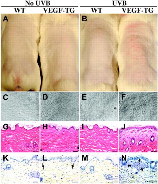Figure 5. Increased wrinkle formation in VEGF-overexpressing mice after long-term UVB irradiation with 3.6 × 10-2 J/cm2. (A) Dorsal skin of nonirradiated wild-type and VEGF transgenic mice. After 10 weeks of UVB irradiation (total dose, 7.92 × 10-1 J/cm2), wild-type mice did not show any macroscopic skin alterations (B, left side), whereas VEGF transgenic mice developed photodamage with wrinkle formation and slight erythema (B, right side) (representative images; n = 10 per genotype). Skin replicas of wild-type and VEGF-overexpressing mice showed no signs of wrinkle formation or texture damage (C-D), nor did those of wild-type mice treated with UVB (E). VEGF-overexpressing mice treated with long-term UVB irradiation, however, did show wrinkle formation and texture damage (F). Histologic analysis and hematoxylin-eosin staining (G-J) revealed that the skin of nonirradiated mice of both genotypes (G-H) and of UVB-irradiated wild-type mice (I) did not reveal any major histologic abnormalities. The skin of UVB-irradiated VEGF-overexpressing mice, however, showed signs of epidermal hyperplasia, edema, inflammatory cell infiltration, and increased vascularization in the papillary dermis (J). LUNA staining (K-N) revealed an irregular organization of elastic and collagen fibers in the papillary dermis of UVB-treated VEGF transgenic mice (N, arrowheads) compared with nonirradiated VEGF transgenic mice (L, arrows) or with wild-type littermates with or without UVB irradiation (K, M). Scale bars, 50 μm. For panels C-F, a Leica M2FLIII microscope equipped with a 1.25 objective (Leica Microsystems, Allendale, NJ) was used. A Niko E-600 microscope equipped with a Plan Fluor 40 × objective with an aperture of 0.75 was used for panels G-N.