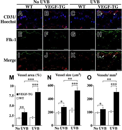Figure 7. Induction of angiogenesis in VEGF transgenic mice after long-term UVB irradiation. Immunofluorescence analysis with antibody against CD31 (A-L) demonstrated prominent vascularization in the papillary dermis of VEGF-overexpressing mice after 10 weeks of chronic UVB irradiation (D, arrowheads), whereas vessels were not altered in wild-type littermates that did or did not undergo UVB irradiation (A, C). VEGF-overexpressing mice also formed tortuous vessels in the upper dermis of nonirradiated skin (B). Expression of VEGFR-2 was up-regulated in the dermal blood vessels of UVB-treated, VEGF-overexpressing mice (H), and this expression colocalized with CD31 (L, arrows). VEGFR-2 expression (F) also colocalized with CD31 (B) at the tortuous vessels in the nonirradiated skin of VEGF-overexpressing mice (J, merged image), whereas VEGFR-2 was weakly expressed or absent in the skin of wild-type mice (I, K). Scale bars, 100 μm. A Plan Fluor 20 × objective with an aperture of 0.50 was used for panels A-L. Computer-assisted morphometric analysis of CD31-stained skin sections after 10 weeks of UVB irradiation revealed a significant increase in the relative area occupied by vessels (M), in average vessel size (N), and in vessel density (O) in VEGF transgenic mice (▪). In contrast, no significant differences were detected in the nonirradiated and irradiated skin of wild-type mice (□). Data are expressed as mean ± SD (n = 5). ***P < .001; **P < .01; *P < .05.