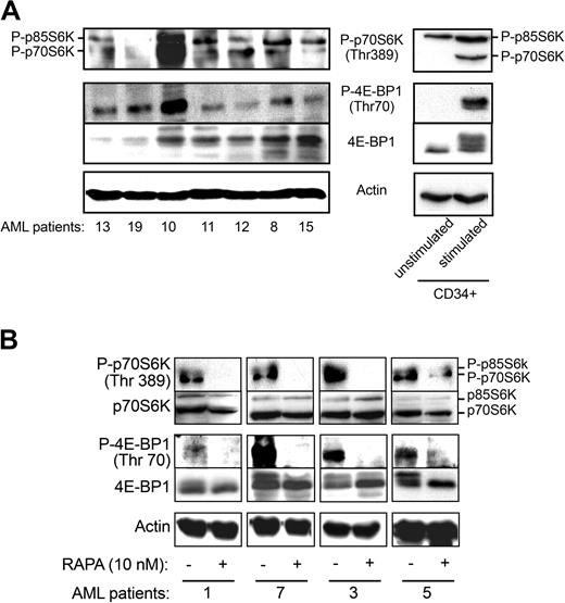 Figure 3. 4E-BP1 and p70S6 kinase are phosphorylated in primary AML cells. (A) Cell lysates (106 cells) from 7 AML patients and normal unstimulated and stimulated (GM-CSF, SCF, and IL-3 for 24 hours) CD34+ HPCs were analyzed by Western blotting with specific antibodies to evaluate the phosphorylation status of 4E-BP1 and p70S6K. The phosphorylation of 4E-BP1 can also be visualized by a shift in the apparent molecular weight of the protein. Results shown are representative of 23 fresh AML samples tested. (B) Fresh AML cells from 4 patients were incubated with RAPA (10 nM) for 24 hours and analyzed by Western blotting with the indicated antibodies.