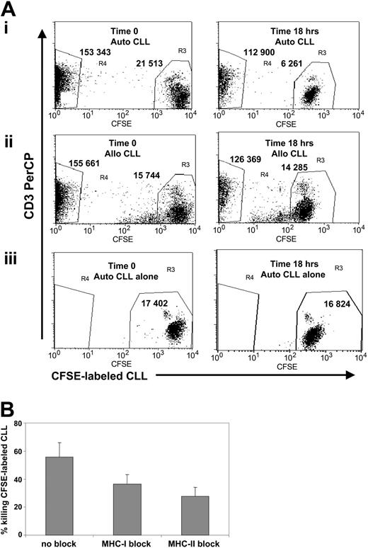 Figure 7. CD40L/OX40L-stimulated T cells have cytotoxic activity against autologous leukemia cells in a CFSE-based flow cytometry assay. (A) The x-axis represents CFSE-labeled B-CLL cells, gated on viable cells, and the y-axis represents the CD3 PerCP-positive population. Numbers represent the events counted in each gate (R3 for B-CLL cells and R4 for CTLs). (left panel) Time 0. (right panel) 18-hour analysis. (i) CFSE-labeled B-CLL cells cocultured with autologous CD40L/OX40L-stimulated T cells. The B-CLL cells are reduced by 71%. (ii) CTLs cocultured with mismatched allogeneic B-CLL cells. B-CLL cells are reduced by 9.3%. (iii) Autologous CFSE-labeled B-CLL cells alone. B-CLL cells are reduced by 3%. (B) Reduction in B-CLL cell numbers (mean + SD; 4 donors tested) with and without MHC class 1 and 2 blocking. Difference was statistically significant (P < .05 for MHC class 1 and class 2 blocking).