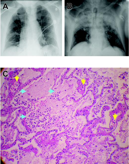 Figure 1. Chest x-rays and microscopic pathology examination of a patient with fatal TRALI. (A) Chest x-ray of the patient before surgery demonstrating low lung volumes with subsegmental bibasilar atelectasis, no evidence of pleural effusion, focal consolidation, or pneumothorax, and normal cardiomediastinal silhouette. (B) Chest radiograph at the time TRALI was recognized, which demonstrates extensive bilateral areas of consolidation in the mid and upper lobes of the lung consistent with aspiration or edema with a normal cardiac silhouette, new since the previous examination earlier on the same day. The endotracheal tube tip is 6 cm above the carina, the nasogastric tube is coiled within the hypopharynx before extending to the proximal trachea, and the right internal jugular introducer sheath tip overlies the proximal superior vena cava. These extensive areas of consolidation in mid and upper lobes are most concerning for noncardiogenic pulmonary edema. (C) Plastic-embedded histologic sections of the lungs at autopsy were stained with hematoxylin and eosin, toluidine blue, or Jones stains, and were examined by light microscopy under an OptiPhot-2 microscope equipped with a 20 ×/0.4 objective lens (Nikon, Melville, NY). Images were photographed with a Nikon CoolPix 4500 camera and acquired with Apple Mac OS × 10.3.5 (Apple, Cupertino, CA) running Portfolio 7 software (Extensis, Portland, OR). There is significant extravasation of PMNs into the alveoli and air spaces with interstitial and intra-alveolar edema (blue arrows). Toluidine blue and Jones stains demonstrate dilated capillaries and a prominence of inflammatory neutrophils in the capillaries and air spaces (yellow arrows). Histologic findings are consistent with early acute respiratory distress syndrome.