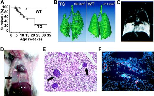 Figure 3. Premature death and pleural effusion in kCYC+/- transgenic mice. (A) Kaplan-Meier survival curves for transgenic (TG) mice (solid line, n = 77) and WT littermates (dotted line, n = 94). (B) A 3-dimensional reconstituted CT image of a TG mouse and a WT littermate with numbers showing air space content. (C) Chylothorax detected by water-enhanced MR images. (D) Chylous fluid (arrow) in pleural cavity following removal of the lungs. (E) H and E staining of lung tissue showing lymphocytes contained within vascular structures near blood vessels (arrows) (× 100). (F) Anti-VEGFR-3 for lymphatics (red) and DAPI (4,6 diamidino-2-phenylindole) staining for nuclei (blue) in lung tissue showing lymphatics filled with cells (× 100).