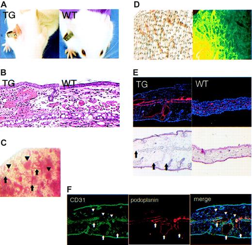 Figure 4. Erythematous ears and blood-filled dermal lymphatics in kCYC+/- transgenic mice. (A) Erythematous ear 1 week after tagging in a TG (left), but not WT (right), mouse. (B) H and E staining of skin from tagged ears showing extravasated erythrocytes and erythrocytes filling vascular structures in TG (left), but not in WT (right), skin (× 100). (C) Whole-mount visualization of an unstained tagged TG mouse ear showing blood within (arrows) and outside of (arrowheads) vascular structures. (D) Whole-mount visualization of a tagged TG ear by light (left) and immunofluorescence (right, podoplanin staining in green) microscopy showing lymphatics filled with blood. (E) Antipodoplanin (red) and H and E staining on serial sections of a tagged TG ear showing dilated lymphatics filled with erythrocytes (arrows) (× 40). (F) Anti-CD31 (green) and antipodoplanin (red) staining of tagged TG ear showing that dilated vessels are CD31 dimly positive and podoplanin positive (arrows), which is consistent with a lymphatic phenotype. By contrast, the nondilated blood vessels are CD31+ and podoplanin negative (arrowheads) (× 40).