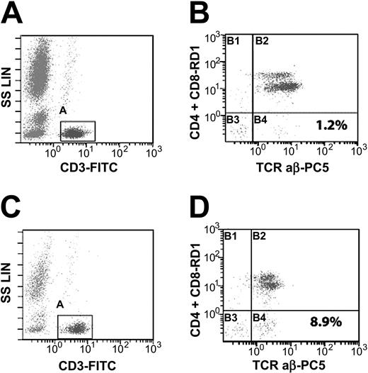 Figure 1. Detection of double-negative T cells and gating strategy. Peripheral blood lymphocytes were analyzed by flow cytometry for DNTs (CD4-/CD8-, CD3+, TCRαβ+). A histogram of CD3-FITC versus side scatter (A,C) was used to gate on T cells (CD3+/low SS). The events in the T-cell gate were sent to second histogram (B,D) of CD4 and CD8-RD1 versus TCRαβ-PC5. Double-negative T cells are depicted in lower right quadrant of panels B and D. Panel B represents a patient with a normal test (1.2% DNTs), and panel D represents a patient with an elevated test (8.9% DNTs). SS LIN indicates side scatter linear.