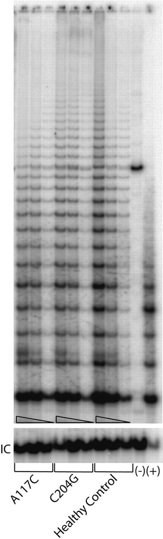 Figure 5. Telomerase enzymatic activities expressed in primary blood cells from the representative patients and healthy individuals. Serial dilutions containing 1.0 μg, 0.5 μg, and 0.1 μg total protein, respectively, from cell lysates for each sample were tested (triangles). Lanes 1 to 9 are from a patient who carries the A117C, or C204, or G305A mutations, respectively. Lanes 10 to 12 are from an unrelated healthy control individual. Lane 13 shows a negative control in which 1 μg lysate from the healthy control sample was denatured at 95°C for 5 minutes prior to assay. (+) indicates PCR products amplified from a control TRS8 template provided in the kit (lane 14). “IC” indicates PCR products amplified from an internal control DNA template, which is used as internal control for PCR amplification efficiency in each reaction.