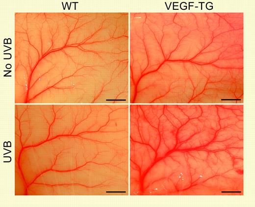Addition of VEGF expressed from a transgene cassette (VEGF-TG) sensitizes the skin to long-term low-dose UVB exposure. See the complete figure in the article beginning on page 2392.