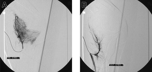 Figure 1. Blush in a patient with elbow bleeding. Angiogram shows massive blush in a patient with recurrent spontaneous elbow bleeding before (A) and after (B) embolization.