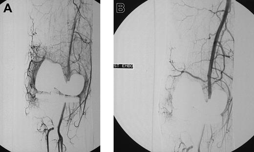 Figure 2. Blush in a patient with knee bleeding. Angiogram shows blush in a patient with recurrent massive knee bleeding following joint replacement before (A) and after (B) embolization.