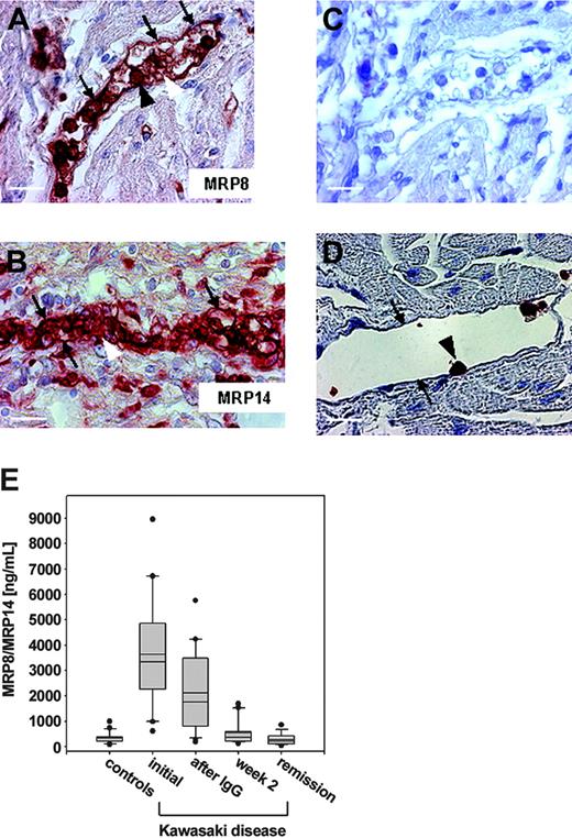 Figure 5. MRP8/MRP14 in Kawasaki disease. Paraffin sections of myocard biopsy specimens from patients with KD (A-C) and a control decedent (D) were stained against MRP8 (A), MRP14 (B,D), and control antibody (C). Labeled are the endothelial layer of a small vessel (small arrows), granulocytes (large black arrows) adherent to endothelial cells, and microthrombi (large white arrows). Scale bars, 20 μm (A,C-D) and 30 μm (B). (E) Serum concentrations of MRP8/MRP14 were determined in 33 healthy children and in 21 patients with KD at initial presentation, 1 day after therapy with IVIG, in the second week after treatment, and in complete clinical remission. Box plots represent median and mean values, quartiles, and the 10th and 90th percentiles (*P < .05).