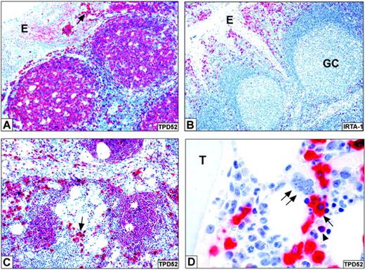 Figure 1. The protein recognized by B28p is expressed in mature B cells and plasma cells. (A) In normal tonsil, B28p reacts with B cells and, more strongly, with plasma cells (arrow); notice the weak positivity of tonsil epithelium (E). (B) The expression pattern of IRTA1 in normal tonsil (as revealed by the M-IRTA1 mAb) clearly differs from that of TPD52, labeling being restricted to a subset of B cells located within and beneath the tonsil epithelium (E). GC indicates germinal center. (C) The expression pattern of TPD52 in a reactive lymph node is similar to that observed in the tonsil; the arrow points to an aggregate of strongly positive plasma cells. (D) In a reactive bone marrow, TPD52 is strongly expressed in plasma cells (arrow) and B cells (arrowhead), while hematopoietic precursors are negative. The double arrow points to a TPD52-negative megakaryocyte. T indicates a bone trabecula. The APAAP technique was used with hematoxylin counterstain. Original magnifications, × 200 (A-C) and × 1000 (D).