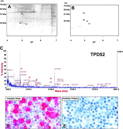 Figure 3. 2D-PAGE and mass spectrometry identify the 28-kDa protein as TPD52. (A-B) Spots S1 and S2 (corresponding to the 28-kDa band in 1D-Western blots in Figure 1) are shown in a silver-stained 2D gel of B28p-positive lymphoma cells (A) and in the corresponding 2D-Western blot probed with the B28 mAb (B). Spot S3, which represented an unspecific reaction also detected in the negative control (U937 cell line; not shown), was not subjected to mass spectrometry analysis. (C) Peptide spectra. Protein S2 was isolated from a Coomassie-stained 2D gel and digested with trypsin. The mass of the resulting fragments was assessed by MALDI-TOF spectrometry. Peptide masses corresponding to TPD52 in S2 are denoted with asterisks: 1222.644 Da, 1454 Da, 1657 Da, and 2099 Da. (D-E) B28p strongly stains Phoenix cells transfected with a construct encoding human TPD52 (D). In contrast, no reactivity is seen toward cells transfected with any of the constructs encoding TPD52L2 (E) or TPD52L1, murine Tpd52, and the empty vector (not shown). The APAAP technique was used with hematoxylin counterstain. Original magnification, × 1000.