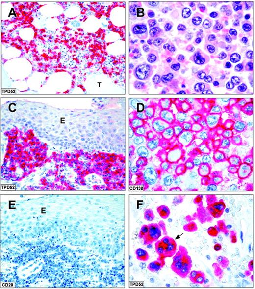 Figure 5. TPD52 expression in lymphomas and myeloma. Strong cytoplasmic expression of TPD52 in a case of hairy cell leukemia (A; paraffin section from bone marrow trephine; original magnification, × 200). T indicates a bone trabecula. Plasmoblastic lymphoma in an HIV-infected patient (paraffin sections): tumor cells express TPD52 (C; original magnification, × 400) but are CD20- (E; original magnification, × 400); E indicates oral epithelium. The APAAP technique was used with hematoxylin counterstain. (B,D,F) Tumor cells in a case of undifferentiated myeloma (B; hematoxylin-eosin; original magnification, × 1000). The myeloma cells strongly express CD138 on the cell surface (D; APAAP technique; hematoxylin counterstain; original magnification, × 1000) and TPD52 in the cytoplasm (F; APAAP technique; hematoxylin counterstain; original magnification, × 1000); the arrow points to a TPD52-positive multinucleated myeloma cell. All panels represent paraffin sections from B5-fixed/EDTA decalcified bone marrow trephines.