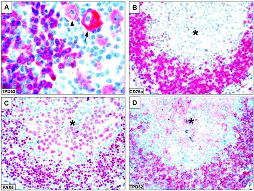 Figure 6. TPD52 expression in Hodgkin lymphoma. (A) Mixed cellularity Hodgkin lymphoma. Mononuclear variants show strong (arrow) and moderate (arrowhead) TPD52 positivity (original magnification × 800). (B-D) Tumor cell–rich Hodgkin lymphoma (original magnification × 400). A nodule of tumor cells (*) that are CD30+ (not shown) and CD79a- (B) displays nuclear staining for PAX5 (C) and cytoplasmic labeling for TPD52 (D). The rim of residual normal B cells at the periphery of the nodule served as positive control. Lymph node paraffin sections. The APAAP technique was used with hematoxylin counterstain.