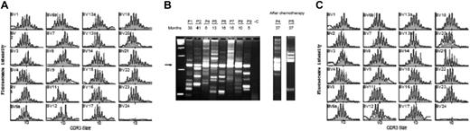 Figure 1. Polyclonality of genetically modified T-cell populations. (A,C) Immunoscope study of Vβ T lymphocytes from P8 and P2, 11 months and 45 months after gene therapy, respectively, and age-matched controls (gray-shaded outline). Vβ usage (black) is similar to normal controls (gray). (B) In vivo 5′LTR integration site analysis of P1, P2, P4, P5, P6, P7, P8, and P9 T-cell clones in 8 patients. Ten to 200 ng of DNA from sorted T cells (CD3+) was analyzed by using LAM-PCR at different time points (5 to 41 months) after gene therapy. The electrophoresed amplification product displays a restriction length polymorphism of integration sites, with each band indicating the presence of a different insertion locus in the assayed material. Presence of a polyclonal population of gene-modified CD3 cells was detected in each patient. Numbers denote months after transplantation. The arrow indicates the internal vector 3′LTR amplification product. A total of 1.0 μg nontransduced human leukocyte DNA was used as a negative control (-C); first lane, 100-bp ladder. After chemotherapy: integration site analysis after chemotherapy in P4 and P5. LAM-PCR was performed on 100 ng of DNA isolated from peripheral blood leukocytes 3 months after induction chemotherapy. Clonality analysis reveals the recurrence of multiple clones contributing to lymphopoiesis.