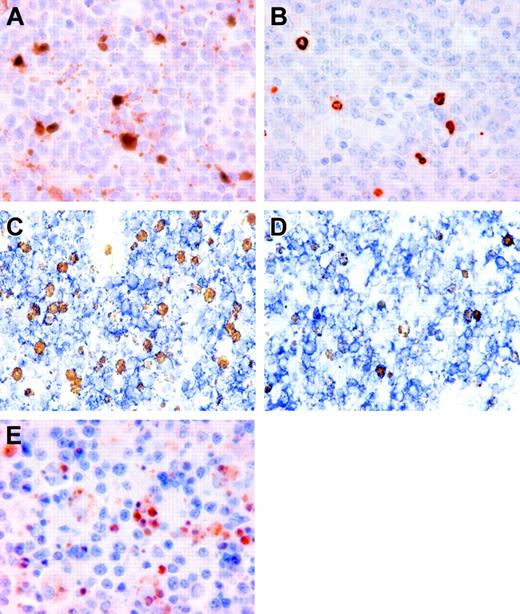 Figure 2. Detection of active caspase 3 and cleaved PARP-1/p89 in biopsy specimens of primary nodal DLBCL. (A) Staining for active caspase 3 demonstrating brown, mostly nuclear, staining primarily in cells with morphologic features of apoptosis. (B) Cleaved PARP-1/p89 staining demonstrated strictly nuclear staining, also primarily in cells with morphologic features of apoptosis. (C) Double staining for active caspase 3 and CD20. (D) Cleaved PARP-1/p89 and CD20 demonstrating that active caspase 3-positive cells and cleaved PARP-1/p89-positive cells (both brown nuclear staining) are CD20+ positive (blue membranous staining) and thus probably neoplastic B cells. (E) Staining for active caspase 8 demonstrating brown, mostly nuclear, staining, also primarily in cells with morphologic features of apoptosis.