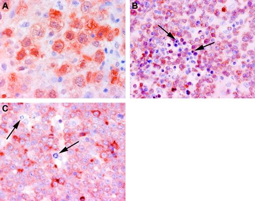 Figure 3. Detection of apoptosis-regulating proteins in biopsy specimens of primary nodal DLBCL. (A) c-Flip demonstrating brown, predominantly cytoplasmic, staining. (B) Bcl-2 demonstrating brown cytoplasmic staining. (C) XIAP demonstrating brown cytoplasmic staining. Arrows indicate apoptotic cells. Note high numbers of cells with apoptotic morphology in clearly Bcl-2- and XIAP-positive patients and the absence of cells with apoptotic morphology in c-Flip-positive patients.