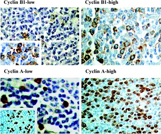 Figure 1. Immunohistochemistry of cyclin B1 and cyclin A. Examples of follicular lymphomas with high and low expression of cyclin A and cyclin B1. (Left) Tumor from patient no. 9 showing low fractions of cyclin B1-positive cells (magnification, × 200) and cyclin A-positive cells (magnification, × 600). Inserts show regions with higher expression, so called hot spots (magnifications, × 600 and × 100). (Right) Tumor from patient no. 55 with high percentages of cyclin B1-positive cells (magnification, × 400) and cyclin A-positive cells (magnification, × 200). Original magnifications, × 200 (top left panel and inset; bottom right panel); × 400 (top right panel; bottom left panel and inset). A Nikon Optishot microscope equipped with 20 ×/0.40 and 40 ×/0.65 objective lenses (Nikon, Tokyo, Japan) was used to visualize images. Pictures were taken with a Nikon CoolPix 990 camera, and Adobe Photoshop 6.0 software was used to zoom images to their present magnitude (Adobe, San Jose, CA).