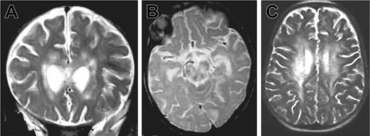 Figure 1. Brain magnetic resonance images of patients 1 and 2. MRIs show large white matter lesions in periventricular areas and brain stem. (A) Patient 1, 7 months, coronal T2 section. (B) Patient 1, 7 months, sagittal T2 section. (C) Patient 2, 33 months, sagittal T2 section.