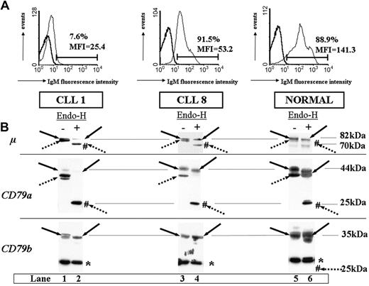 Figure 1. Differences in IgM surface expression profiles and BCR component glycosylation status between CLL patients and healthy subjects. (A) Flow cytometry analysis of surface IgM staining. Results from 2 patients, one with weakly expressing IgM (CLL 1 in Table 1) and one expressing IgM more strongly (CLL 8 in Table 1), and from a representative healthy subject are shown. Preparations enriched in B cells were subjected to flow cytometry, comparing isotype control staining (bold line) with test mAb staining (thin line). Fluorescence intensities are shown on a logarithmic scale on the x-axis. We report the percentage of positive cells and mean fluorescence intensity of IgM staining. (B) Glycosylation analysis of BCR components. Cell extracts (20 μg) produced by lysis in MBS were incubated at 37°C in the presence (+) or absence (-) of Endo-H and separated by 10% SDS-PAGE, and the resulting protein bands were transferred to nitrocellulose. Filters were probed with mAbs as follows: rabbit anti-μ heavy chain (μ), mouse anti-CD79a (CD79a), or anti-CD79b (CD79b), and immunoreactive bands were detected with an appropriate horseradish peroxidase-linked secondary antibody. Immature glycosylated (dotted arrows) and mature glycosylated (solid arrows) proteins are indicated for each staining. Forms deglycosylated by Endo-H treatment are indicated by #. Molecular masses are indicated in kilodaltons (kDa). The asterisk indicates a nonspecific band at 30 kDa constantly observed with the anti-CD79b probe from Pharmingen.