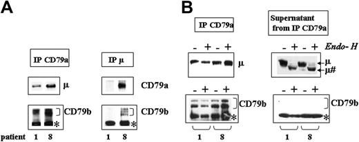 Figure 3. Analysis, by coimmunoprecipitation assays, of the assembly of BCR components in CLL patients. (A) Analysis of molecules associated with μ or CD79a. B cells from patients 1 and 8 were lysed in digitonin and the resulting cell extract was immunoprecipitated with Abs against CD79a (left panel) or μ (right panel) chains. Immunoprecipitates (IP) were analyzed with anti-μ, anti-CD79a, or anti-CD79b mAbs. (B) Study of the glycosylation status of the molecules associated and unassociated with the CD79a chain. B cells from patients 1 and 8 were lysed in digitonin and the resulting cell extract was immunoprecipitated with anti-CD79a mAb. IP or supernatants from the IP were treated in the presence (+) or the absence (-)of Endo-H and analyzed using anti-μ (top row of blots) or anti-CD79b (bottom row) Abs. μ# indicates the deglycosylated form of μ chains after Endo-H treatment. *Nonspecific band observed with the anti-CD79b probe.