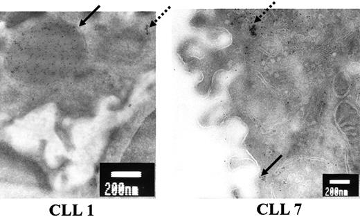 Figure 4. Analysis of μ chain aggregation by electron microscopy. Ultrathin cryosections of B cells from patients 1 and 7 were processed for postembedding immunogold labeling with anti-μ mAb followed by incubation with secondary antibodies conjugated to 6 nm colloidal gold. Bold arrows indicate gold-labeled μ chains in a megavesicle for patient 1 and in a small vesicle moving toward the cell surface for patient 7. Dotted arrows indicate gold-labeled μ chains in the ER in both patients. Bars = 200 nm. Original magnification, × 20 000.