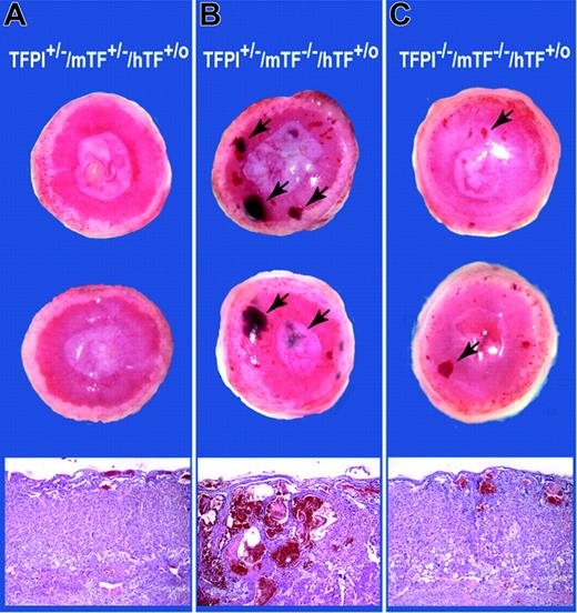 Figure 4. Analysis of placentas containing different levels of TFPI and TF. Representative E15.5 placentas from a cross between a TFPI–/–/low-TF male and a TFPI+/–/mTF+/–/hTF+/o female. Macroscopic surface views of placentas are shown. (A) TFPI+/–/mTF+/–/hTF+/o placentas. (B) TFPI+/–/mTF–/–/hTF+/o placentas. (C) TFPI–/–/mTF–/–/hTF+/o placentas. Blood pools in panels B and C are shown with arrows. Histologic analysis (H&E) of the placentas is shown. Original magnification, × 40.