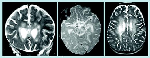 Brain magnetic resonance images of patients 1 and 2. See the complete figure in the article beginning on page 2658.