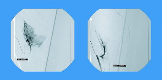 Blush in a patient with elbow bleeding. See the complete article by Mauser-Bunschoten et al, beginning on page 2654.