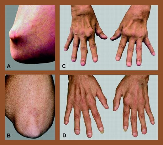 Allogeneic NST for refractory rheumatoid arthritis. Elbow and hands of a patient with refractory RA before (A,C) and after (B,D) allogeneic NST from an HLA-matched sibling. Reprinted from Burt et al4 with permission from Arthritis & Rheumatism, copyright (2004).