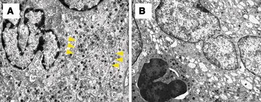 Figure 5. Ultrastructural examination of megakaryocytes derived from BACH1 transgenic mice. Panels show electron micrographs of megakaryocytes derived from the bone marrow of a wild-type littermate (A; original magnification × 4000) and a transgenic mouse (B; original magnification × 4000). Megakaryocytes derived from the transgenic mouse exhibited insufficient demarcation membrane formation and had a decreased number of cytoplasmic α granules. Yellow arrowheads indicate the demarcation membrane in megakaryocytes from a wild-type littermate.