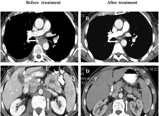 Figure 3. Response of a patient with peripheral T-cell NHL to bortezomib and PegLD. This 64-year-old male with peripheral T-cell non-Hodgkin lymphoma was initially treated with 6 cycles of chemotherapy with cyclophosphamide, adriamycin, vincristine, and prednisone followed by involved field radiation to the mediastinum, resulting in a complete remission. After his disease relapsed he received salvage chemotherapy with ifosfamide, carboplatin, and etoposide, and autologous peripheral blood stem cell transplantation, again resulting in a remission. Upon relapse he received 2 cycles of the histone deacetylase inhibitor depsipeptide with disease progression and then received 6 cycles of bortezomib and PegLD. A complete remission was documented by computed tomography, with resolution of both mediastinal (compare panels A and B) and abdomino-pelvic adenopathy (compare panels C and D) and confirmed by positron emission tomography. Arrows indicate areas of peri-aortic adenopathy in the mediastinum (A) and abdomen (C) that have resolved after therapy (B and D, respectively).