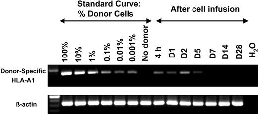 Figure 1. Transient persistence of donor cells following haploidentical NK-cell infusions without in vivo expansion after Lo-Cy/mPred. Each donor/recipient pair was evaluated for a unique class I MHC allele present in the donor but not the recipient. After reverse transcription, PCR primers were chosen to amplify donor-derived informative transcripts without cross reactivity with recipient alleles. A standard curve was established using donor cell dose titration, while showing little or no product in the control sample that does not contain donors cells. Patient PBMC samples were analyzed in a similar manner at various time points after infusion. Shown is a representative donor/recipient pair where HLA-A1 was informative (β-actin control for equal sample loading). There was persistence of donor cells through day 5 (D5) after NK-cell infusion but none at later time points. There was no consistent increase in band density after infusion, suggesting that in vivo expansion did not occur. A similar pattern demonstrating persistence of donor cells through day 5 was seen in 5 of 6 donor/recipient pairs tested.