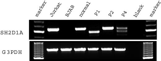Figure 2. SH2D1A mRNA expression in T cell lines derived from patients with XLP. RNA was extracted from the transformed T cell lines derived from the patients with XLP and a healthy control. Then RT-PCR was performed with primer pairs flanking the coding region of the SH2D1A gene. Marker indicates molecular marker; Jurkat, T-lymphoid cell line, positive control; BJAB, B-lymphoid cell line, negative control; normal, healthy control; P1, patient 1; P2, patient 2; P4, patient 4; blank, amplified without DNA.