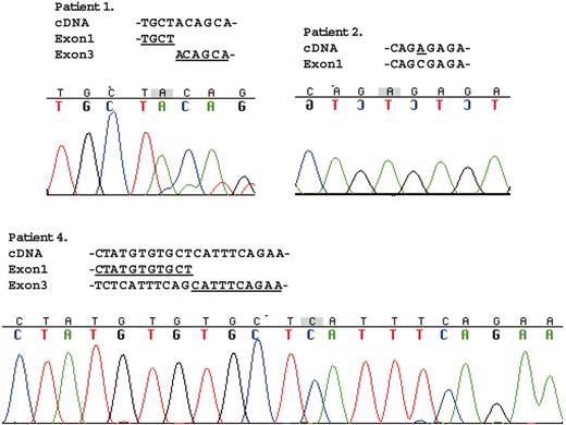Figure 3. Mutational analysis of SH2D1A mRNA from the patients with XLP. Direct sequencing of the RT-PCR products was performed with the same primer pairs used for PCR amplification. The amplified fragment from patient 1 totally lacked exon 2. Data for patient 2 showed the same 102C>A missense mutation as in the genomic mutational analysis. Of the 2 different size-amplified fragments from patient 4, the longer fragment had no mutations (data not shown). The shorter fragment lacked exon 2 entirely and the first 55 nucleotides of exon 3.