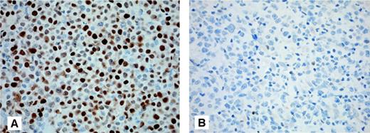 Figure 4. Expression of Mum1/IRF4 in primary cutaneous large B-cell lymphoma. Neoplastic B cells of primary cutaneous large B-cell lymphoma of the leg show a positive staining for Mum1/IRF4 (A), whereas neoplastic cells of primary cutaneous follicle center cell lymphoma are Mum1/IRF4-negative (B) (original magnification × 200; Zeiss Axioshop 2 plus). Images were captured with a Leica DM6000B microscope (Leica, Rijswijk, The Netherlands), using an HCPlan APO objective lens (200×/0.70) and a ProgRes C10 camera with ProgRes10 software (JenaOptik, Jena, Germany).