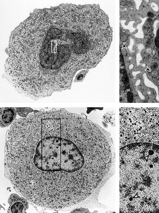 Figure 2. Ultrastructure of megakaryocytes from a healthy bone marrow donor and an MDS patient. (A) Ultrastructure of a megakaryocyte from a healthy bone marrow donor demonstrating structural features characteristic for normal megakaryocytes. The right panel shows a higher magnification of the cytoplasm highlighting the demarcation membrane system (arrowheads). Original magnification × 3200 (left); and × 20 000 (right). (B) Ultrastructure of an MDS megakaryocyte showing chromatin speckles in the nucleus that has smooth outlines. The right panel shows the speckles (open arrowheads) and the poorly developed circular loops in the demarcation membrane system. Original magnification × 10 000 (left); and × 20 000 (right). Images were acquired using a Philips EM-201 electron microscope (Philips, Eindhoven, The Netherlands), diaphragm 30 μm; images were photographed directly by the microscope using 35-mm film from Eastman Kodak (New York, NY) and were subsequently scanned with a Heidelberg Topaz scanner using Linocolor 6.0 software (Heidelberger Druckmaschinen, Heidelberg, Germany). Images were further processed with Adobe Photoshop CS and Illustrator CS (Adobe, San Jose, CA).