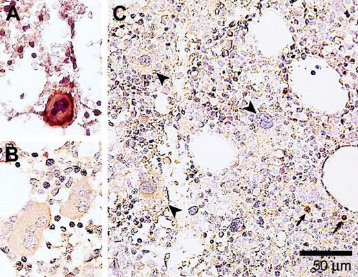 Figure 4. Immunohistochemical detection of activated caspase-3 in megakaryocytes from a healthy donor, and MDS and ITP patients. (A) A bone marrow biopsy from an ITP patient showing a caspase-3 immunopositive megakaryocyte. (B) Bone marrow of a healthy donor has been immunostained in the same way. Note that the megakaryocytes are free of caspase-3 reactivity. (C) A bone marrow sample of an MDS patient showing megakaryocytes (indicated by arrowheads) that are negative for activated caspase-3. Small arrows indicate caspase-3 immunopositive labeling in normoblasts. Magnification × 400. Slides were observed with an Olympus BX50 microscope (Paes Nederland, Zoeterwoude, The Netherlands) using a 40×/0.75 numerical objective lens. Images were captured with an Olympus DP70 camera (Paes Nederland) and image analysis software (SIS, Münster, Germany). Images were further processed using Adobe Photoshop CS and Illustrator CS (Adobe).