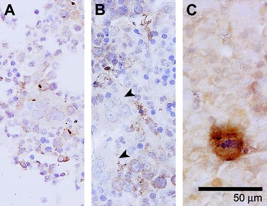Figure 5. Activated caspase-8 in megakaryocytes from a healthy donor and MDS patients. (A) A bone marrow sample from a healthy control. No caspase-8 activity is detected in the megakaryocytes. (B) Bone marrow of an MDS patient showing activated caspase-8 immunonegative megakaryocytes (detected in 5/21 samples, in < 10% of megakaryocytes; indicated by arrowheads). (C) Bone marrow sample of another MDS patient showing a megakaryocyte that is positive for activated caspase-8. Magnification × 400. Slides were observed with an Olympus BX50 microscope (Paes Nederland, Zoeterwoude, The Netherlands) using a 40×/0.75 numerical objective lens. Images were captured with an Olympus DP70 camera (Paes Nederland) and image analysis software (SIS, Münster, Germany). Images were further processed using Adobe Photoshop CS and Illustrator CS (Adobe).