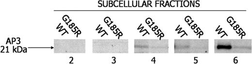 Figure 6. Loss of immunologically detectable AP3 in G185R cells. Subcellular fractions from WT NE- and G185R NE-transduced cells were blotted with antibody to AP3. AP3 localizes to fractions 4 to 6 in WT cells but is undetectable in identical fractions from G185R-transduced cells.