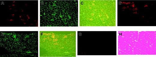 Figure 5. Immunofluorescence staining of muscle sections of the tibialis anterior of hemophilia B dogs injected 2 (dog F57) or 3 (dog D99) years earlier with AAV-CMV-canine F.IX by isolated limb perfusion. (A, D). Fluorescence of rhodamine (red) showing presence of canine F.IX in muscle fibers of ILP injected dogs F57 (A) or D99 (D). (B, E) Fluorescence of fluorescein isothiocyanate (FITC; green) showing presence of heparan sulfate proteoglycan (HSPG) in fibers of tibialis anterior of dog F57 (B) or D99 (E). (C, F) Simultaneous excitation of both fluorescence tags. (G) Fluorescence of rhodamine showing absence of canine F.IX expression in muscle biopsy from dog E59 (infusion of vector by peripheral vein). (H) Hematoxylin and eosin staining of same samples of dog (F57). For all panels, original magnification ×100.
