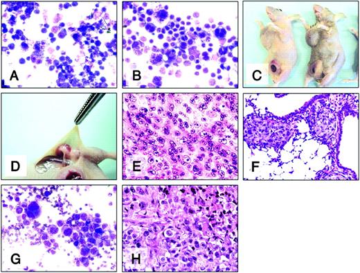 Figure 4. Effect of IL-4 cytotoxin on infiltrating Hodgkin lymphoma. H-RS cells (Giemsa staining; A, L1236; B, HD-MyZ) were injected subcutaneously into beige/nude/X-linked BR immunodeficient mice. (C) Representative image of mice developing subcutaneous primary HD-MyZ tumors and axillary and iliac lymph node swellings. (D) Swelling was not detectable in iliac lymph nodes of mice receiving IL438-37-PE38KDEL intraperitoneally (200 μg/kg dose). H&E staining of subcutaneous HD-MyZ tumor (E), lung (F), and axillary lymph node (H) harvested from untreated mice. (G) Giemsa staining of aspirated fluids from axillary lymph node of untreated mouse. Original magnifications, × 200 (A-B, E-G) and × 400 (H).