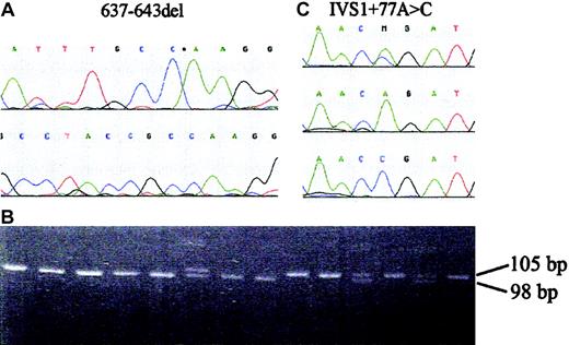 Figure 1. FANCG mutation and SNP. (A) Sequence of part of exon 5 of the FANCG gene showing the c.637_643delTACCGCC mutation (637-643del). (B) PCR assay for the FANCG deletion. Samples from African FA patients; the final 2 lanes are a heterozygote and a normal control, respectively. The normal allele is 105 bp in length and the mutant allele 98 bp. (C) Sequence of part of intron 1 of the FANCG gene showing the c.84 + 77A > C SNP (IVS1 + 77A > C).