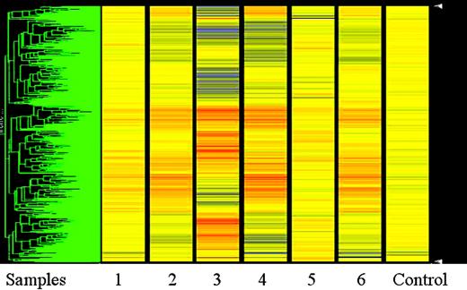 Figure 1. Heat map with unsupervised clustering analysis of the 6 MCL samples compared with normal control. The MCL samples are numbered 1 to 6. The control sample is at the far right of the heat map. All the samples were normalized to the control sample using the Genespring software. The data points are colored by expression with lower signal values colored blue and higher values, red. Yellow signifies expression values equal to the control sample.