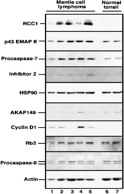Figure 4. Immunoblotting analysis was performed to confirm the expression of several proteins identified in protein microarrays by using the rest of the total protein extracted for the microarray procedure. Protein from control B-lymphocyte extracts was loaded twice (normal tonsil) on each side of the gel. The nitrocellulose blots were probed with monoclonal anti-RCC1, p43/EMAPII precursor, procaspase-7, inhibitor 2, Hsp90, AKAP149, cyclin D1, Rb2, and procaspase-8. Loading control was performed with antiactin antibody (bottom row).