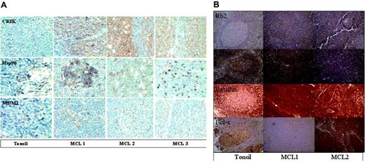 Figure 5. Immunohistochemistry analysis to confirm the presence of the expression of the proteins in the MCL samples and confirm the absence of expression differences in other proteins not detected by the protein microarray. Paraffin-embedded tissue biopsies available from the same patients were analyzed using antibodies to human proteins: CRIK-L, Hsp90, and MDM2 (A); Rb2, KU80, Paxillin, and Bcl-x (B). Images were visualized under an Olympus IX70 inverted microscope equipped with objective lenses from 20 ×/0.40 and 60 ×/0.70 (Olympus, Tokyo, Japan). A MagnaFire digital camera (model 599806) and MagnaFire software version 4.1 were used to capture images (Olympus).